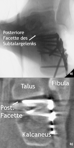 Offene Reposition über erweiterten lateralen Standardzugang und interne Fixation mit Plattenosteosynthese einer Kalkaneusfraktur.