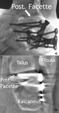 Offene Reposition über erweiterten lateralen Standardzugang und interne Fixation mit Plattenosteosynthese einer Kalkaneusfraktur.