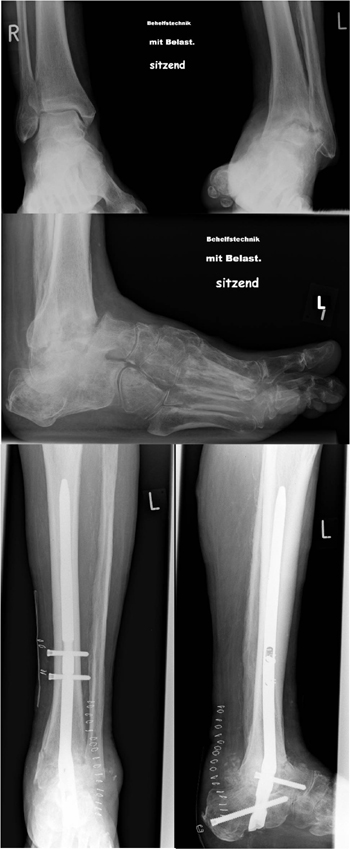 Bei diesem Fall handelt es sich um eine massive Arthrose im oberen und unteren Sprunggelenk mit Deformität und Instabilität.