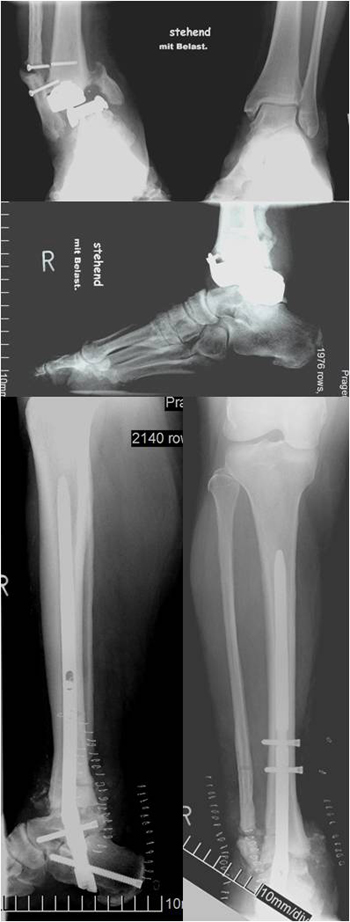 Bei diesem Fall handelt es sich auch um eine OSG Prothese allerdings bereits nach mehrfacher Revision mit Deformität, Instabilität und Ermüdungsbrüchen von Innen- und Außenknöchel.