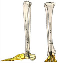 Implantierter A3 Nagel, Ansicht von außen (links)  Implantierter A3 Nagel, Ansicht von hinten (rechts)