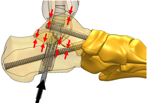 Kompression zwischen Kalkaneus und Talus und zwischen Talus und Tibia durch den Kompressionsbolzen.