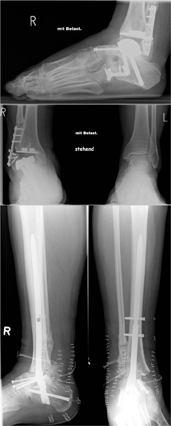 Bei diesem Fall handelt es sich um eine OSG Prothese mit Deformität und Instabilität.