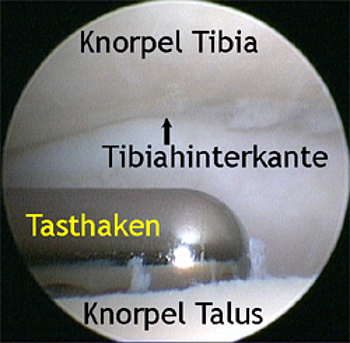 Arthroskopische Gelenkübersicht des oberen Sprunggelenks. 