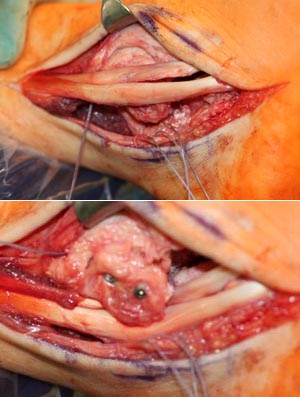 Peronealsehnenluxation (oben) und Rekonstruktion mit an der distalen Fibula gehobenem, verschobenem und fixiertem Knochenfragment (unten) um die Sehen an der korrekten Stelle hinter dem Außenknöchel zu halten.