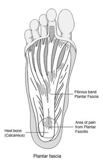 Heel bone = Fersenknochen; Fibrous band Plantar Fascie = Fibröses Band Plantarfaszie; Plantar Fascia = Plantarfaszie