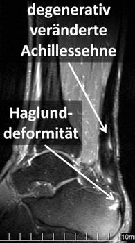 MRT mit massiver Verdickung der Achillessehne und Haglunddeformität