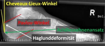 Standardröntgenaufnahme mit massiver Haglunddeformität