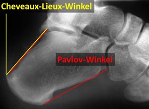 Zustand nach Entfernung einer Haglunddeformität mit deutlich positivem Cheveaux-Lieux-Winkel und Pavlov-Winkel (Beschreibung der Winkel s.o.).